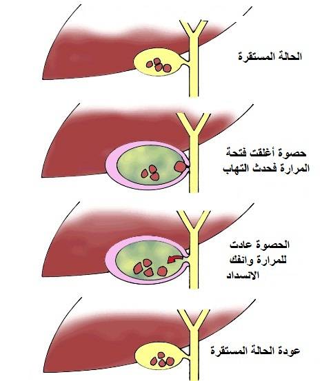 أسباب وأعراض التهاب المرارة