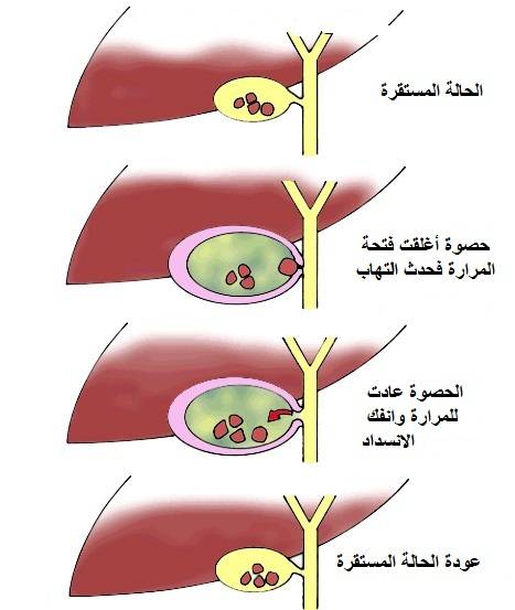 اعراض المراره