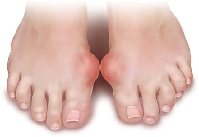 أسباب وأعراض مرض النقرس