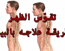 تمارين علاج تقوس الظهر