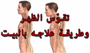 تمارين علاج تقوس الظهر
