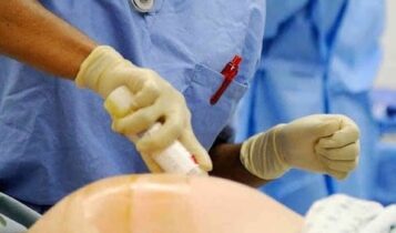 كيفية إخفاء آثار الولادة القيصرية