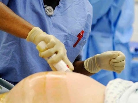 كيفية إخفاء آثار الولادة القيصرية