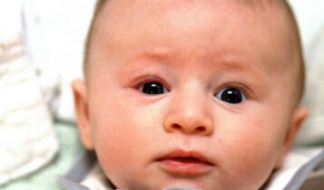 أسباب إلتهابات العين عند الأطفال