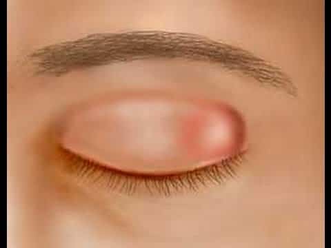 كيفية علاج دمل العين