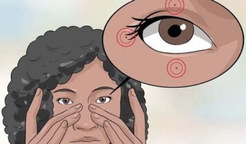 كيفية علاج رفة العين