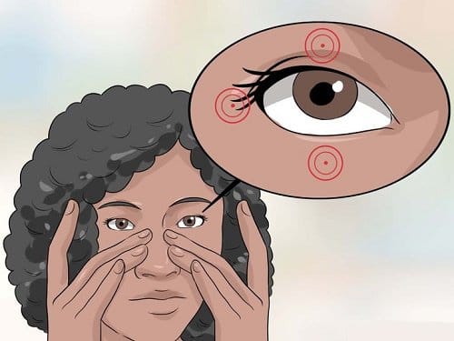 كيفية علاج رفة العين