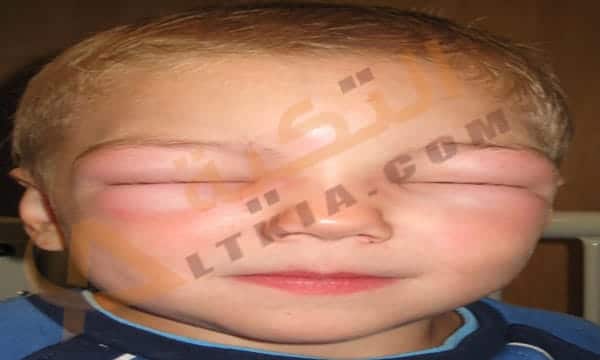 تورم الوجه