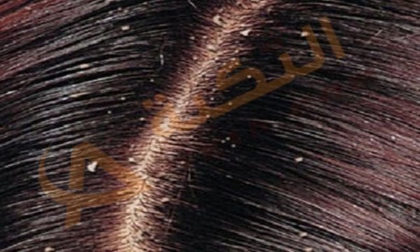 أسباب ظهور قشرة الشعر