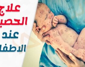 الحصبة عند الأطفال