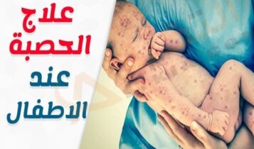 الحصبة عند الأطفال
