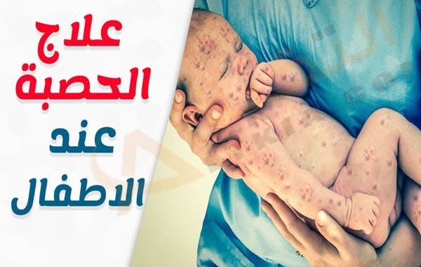 الحصبة عند الأطفال