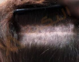 عملية زراعة الشعر