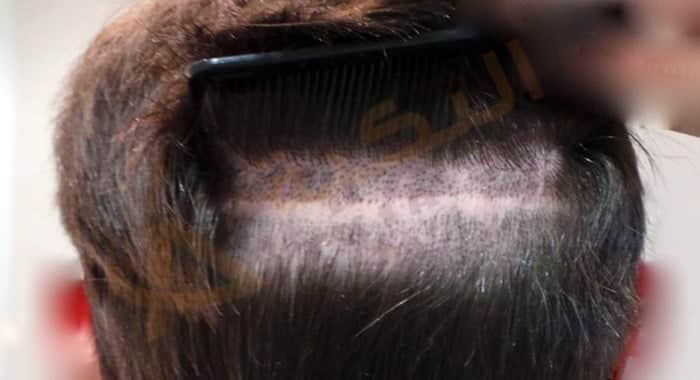 عملية زراعة الشعر