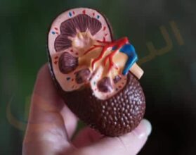 حصوة الكلى