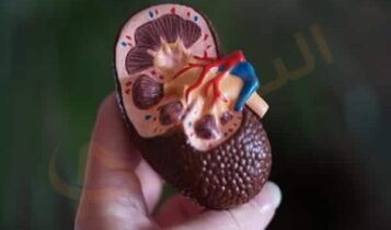 حصوة الكلى