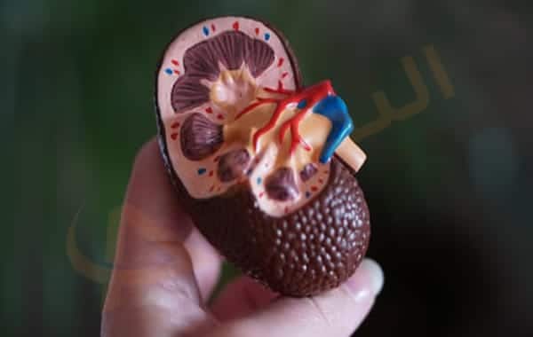 حصوة الكلى