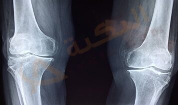 تلين الغضروف
