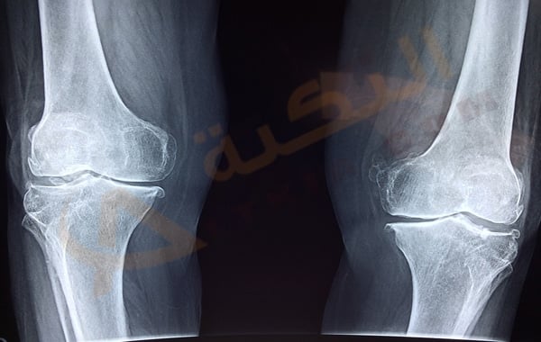 تلين الغضروف
