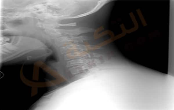 داء الفقار العنقي 