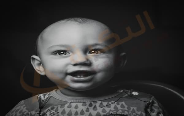 صديد العين