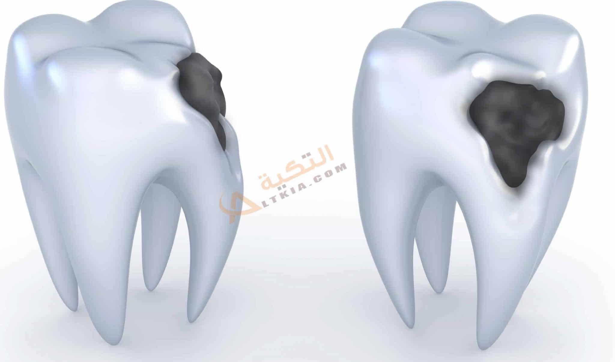 تسوس الأسنان الأسباب الأعراض العلاج وطرق الوقاية