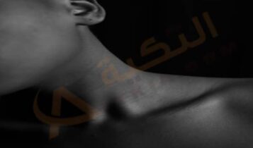 تضخم الغدة الدرقية