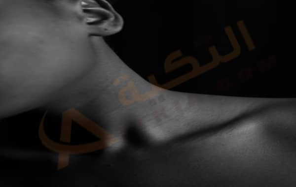 تضخم الغدة الدرقية