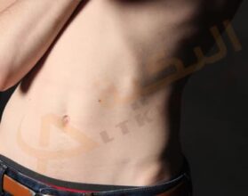غازات واضطرابات البطن