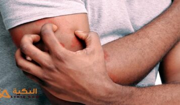 علاج حكة الجلد بالأعشاب
