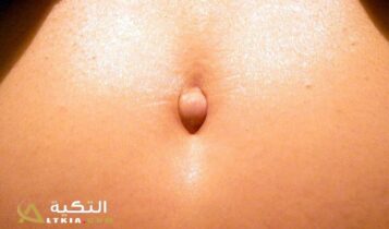 شلع السرة