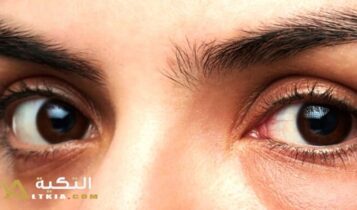 أسباب الانتفاخ تحت العين