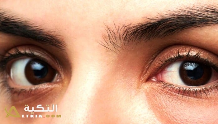 أسباب الانتفاخ تحت العين