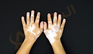 البهاق عند الأطفال
