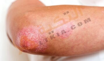 علاج الصدفية بالأعشاب الطبيعية