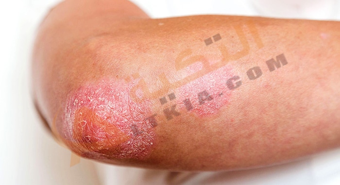 علاج الصدفية بالأعشاب الطبيعية