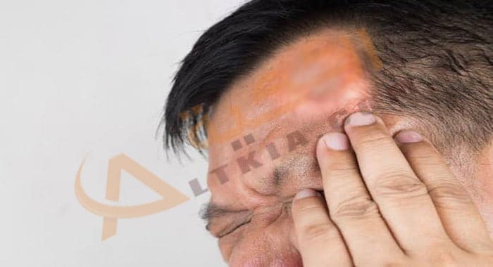تفسير حلم خروج الدم من الرأس في المنام