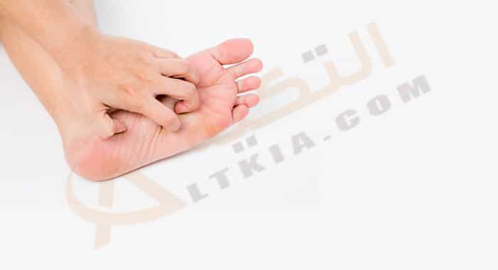 علاج حكة باطن القدم بالأعشاب