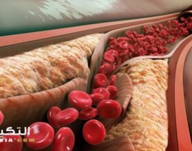 علاج ضيق الشرايين بالأعشاب