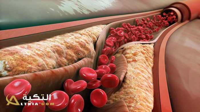 علاج ضيق الشرايين بالأعشاب