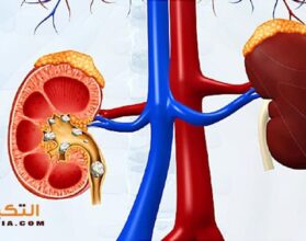 علاج حصى الكلى بالأعشاب
