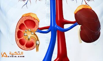 علاج حصى الكلى بالأعشاب