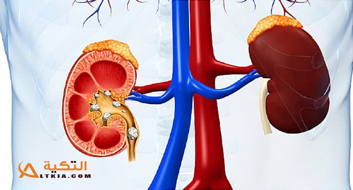 علاج حصى الكلى بالأعشاب
