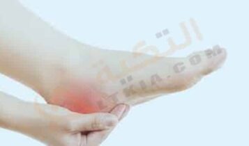 الفرق بين النقرس والشوكة العظمية