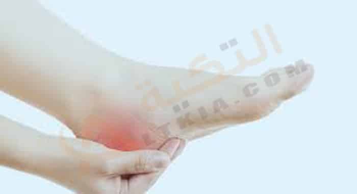 الفرق بين النقرس والشوكة العظمية