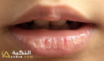 تشقق الشفاه