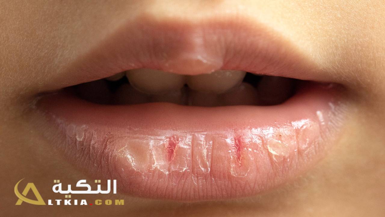تشقق الشفاه